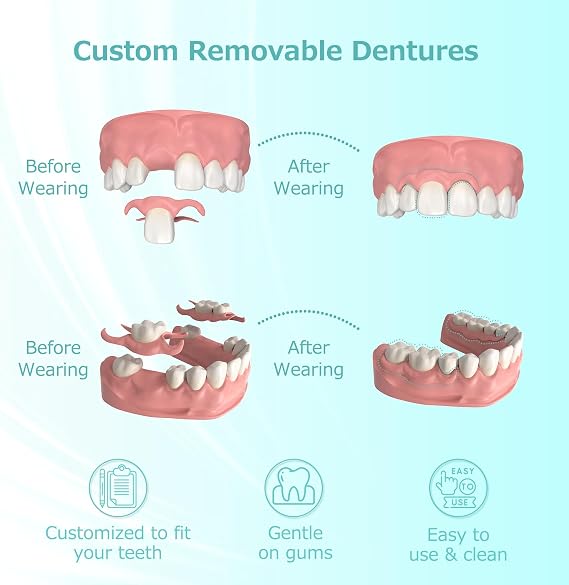 Custom Partial Dentures for Missing Teeth, Removable Dentures (1 Tooth) | Composite Resin Dentures for Tooth Replacement, Custom fit Temporary Tooth, Easy to Use, Create Your Perfect Smile at Home