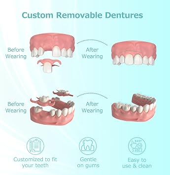 Custom Partial Dentures for Missing Teeth, Removable Dentures (1 Tooth) | Composite Resin Dentures for Tooth Replacement, Custom fit Temporary Tooth, Easy to Use, Create Your Perfect Smile at Home
