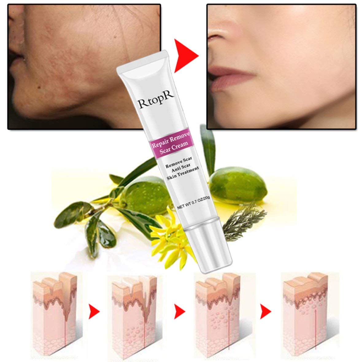Buy RtopR Acne Scar Removal Cream Fast Skin Tag Remover Remove Scar
