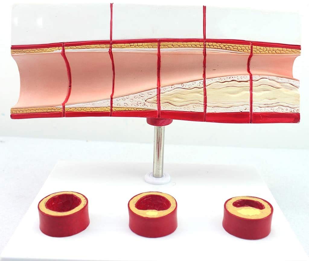 Thrombose Modèle De Processus - Maladie Cardiaque Coronaire Matériel Médical Modèle -PVC Coeur Humain Éducation Médicale Modèle Anatomique pour L'Éducation Médicale