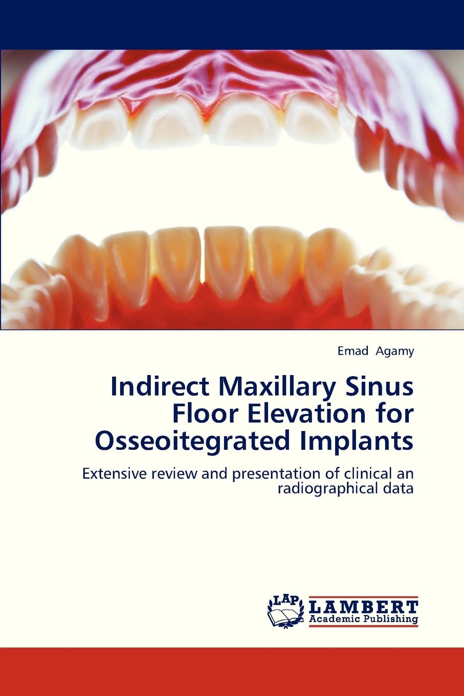 Indirect Maxillary Sinus Floor Elevation for Osseoitegrated Implants: Extensive review and presentation of clinical an radiographical data