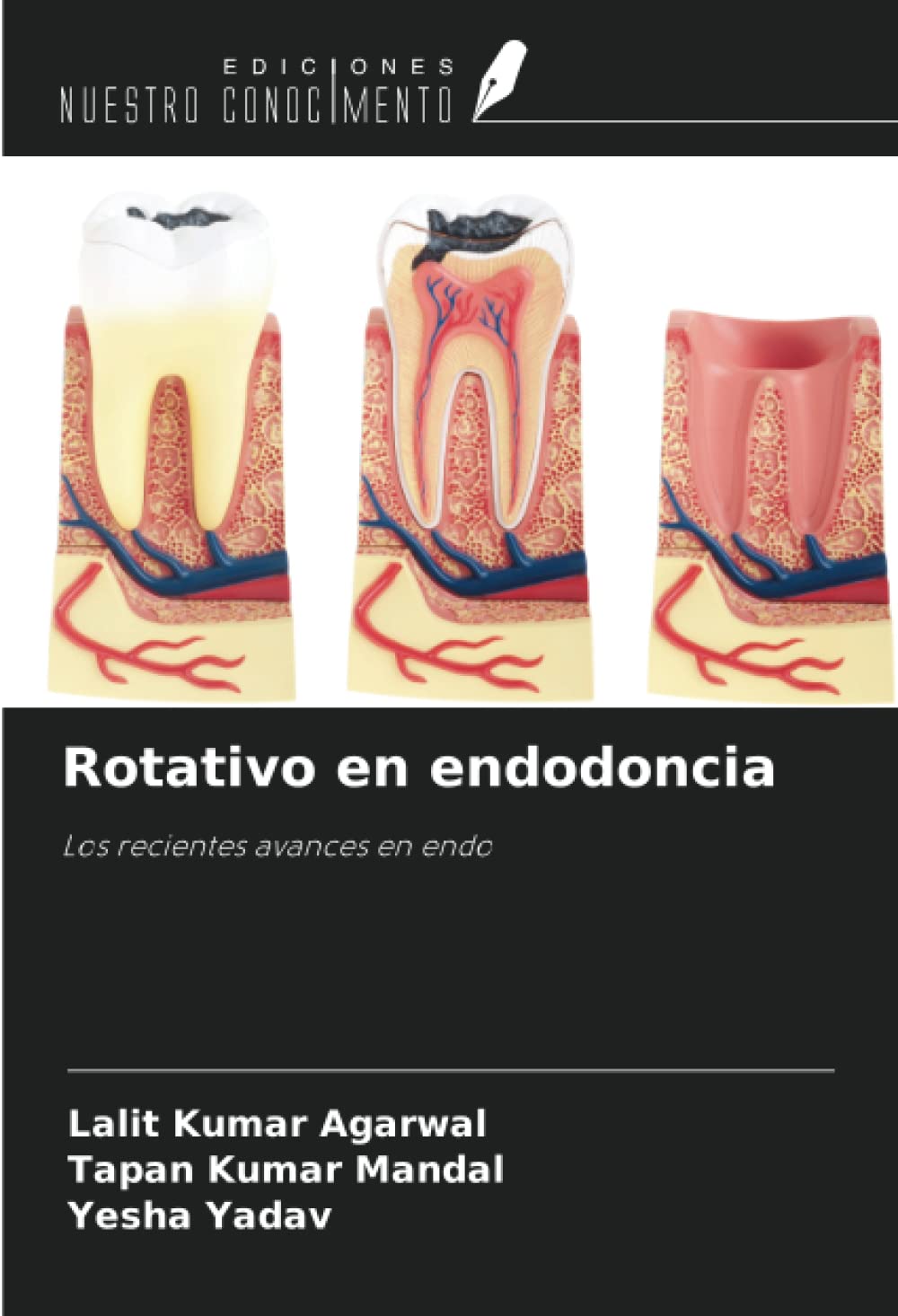 Rotativo en endodoncia: Los recientes avances en endo
