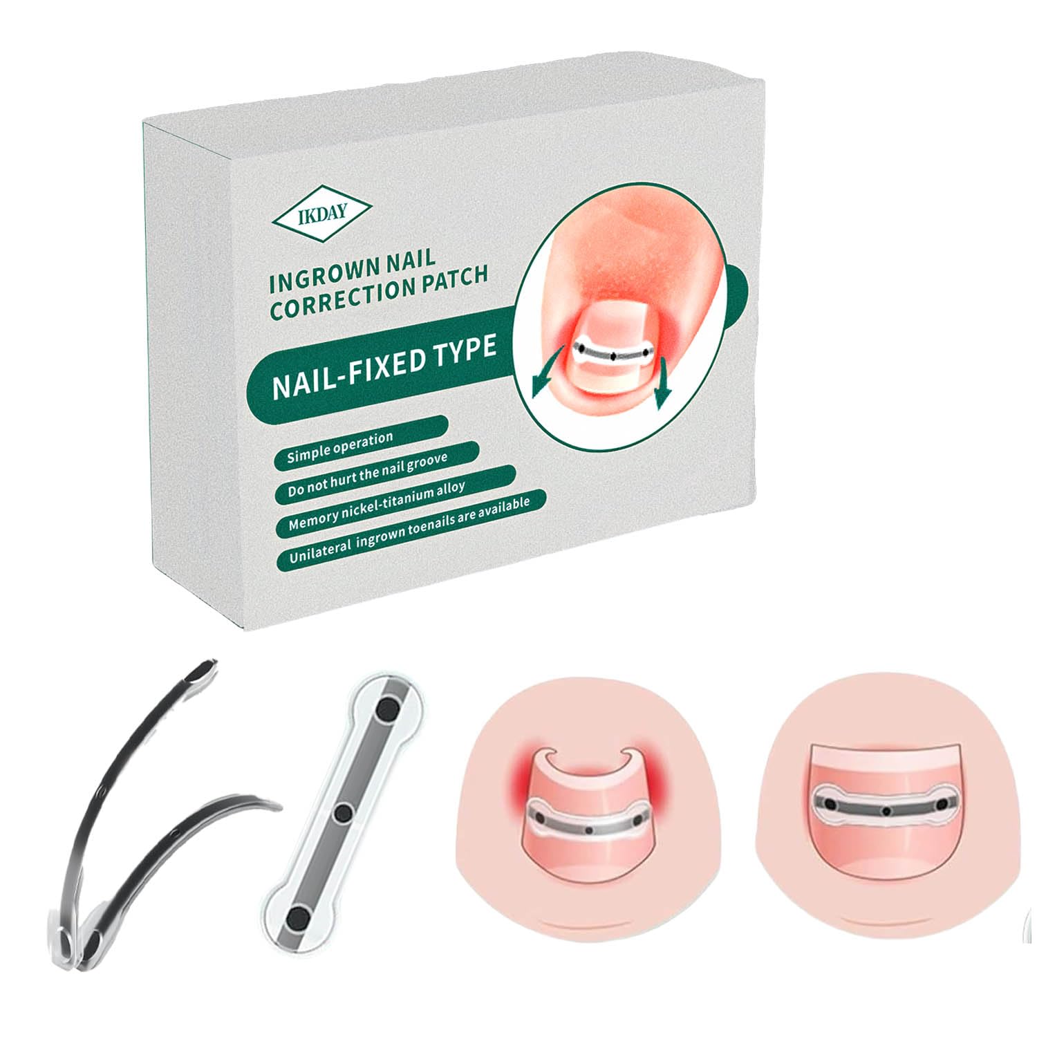Ingrown Toenail Corrector & Removal Kit - at Home Treatment for Ingrown Toenails, Titanium Alloy Ingrown Toenail Treatment Tools Designed for Curved Nail Repair Suitable for Men Woman (0.59/0.67in)