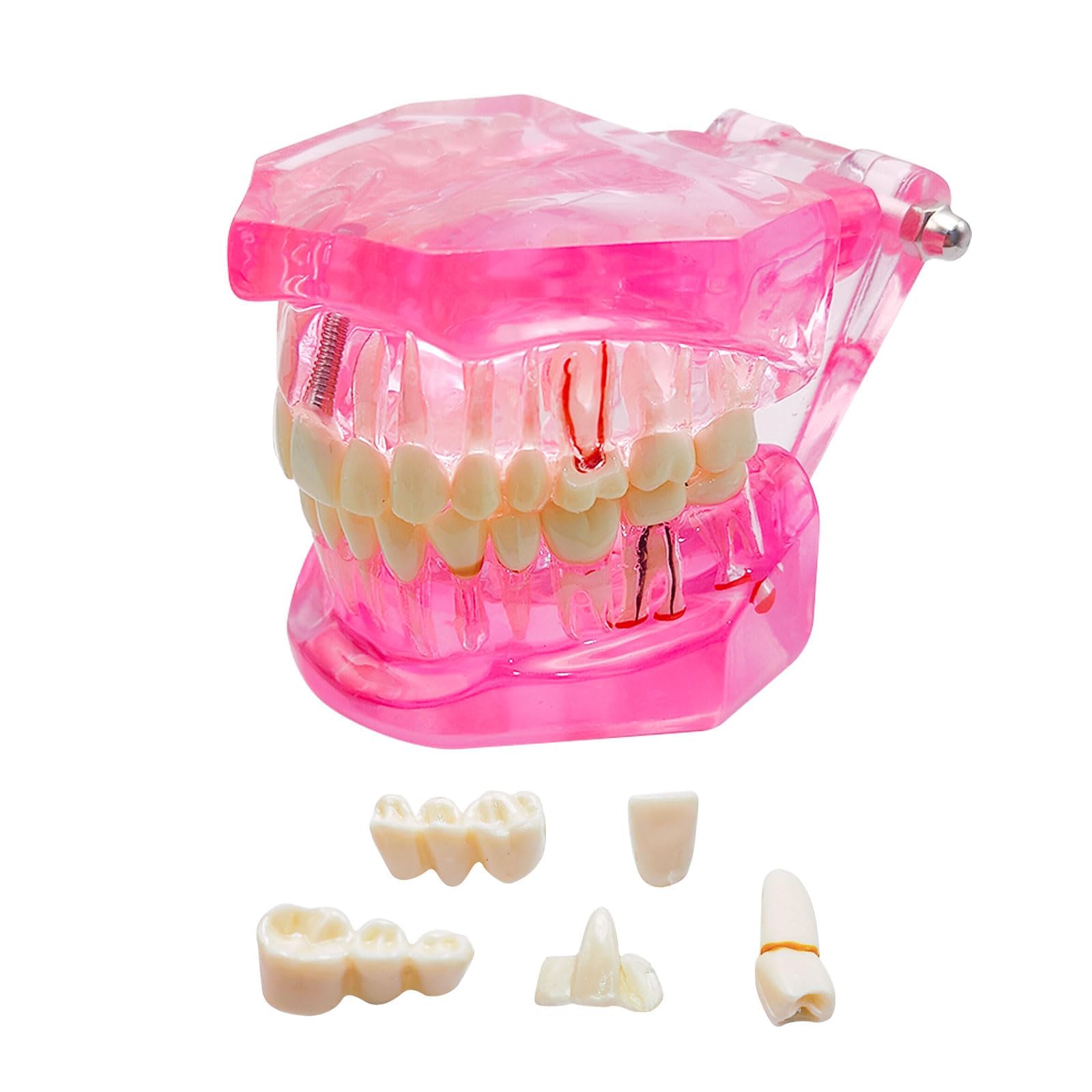Windplusya Transparent Disease Teeth Model with Dental Implant Bridge, Dental Teach Crown Bridge Removable Model, Tooth Model for Patient and Dental