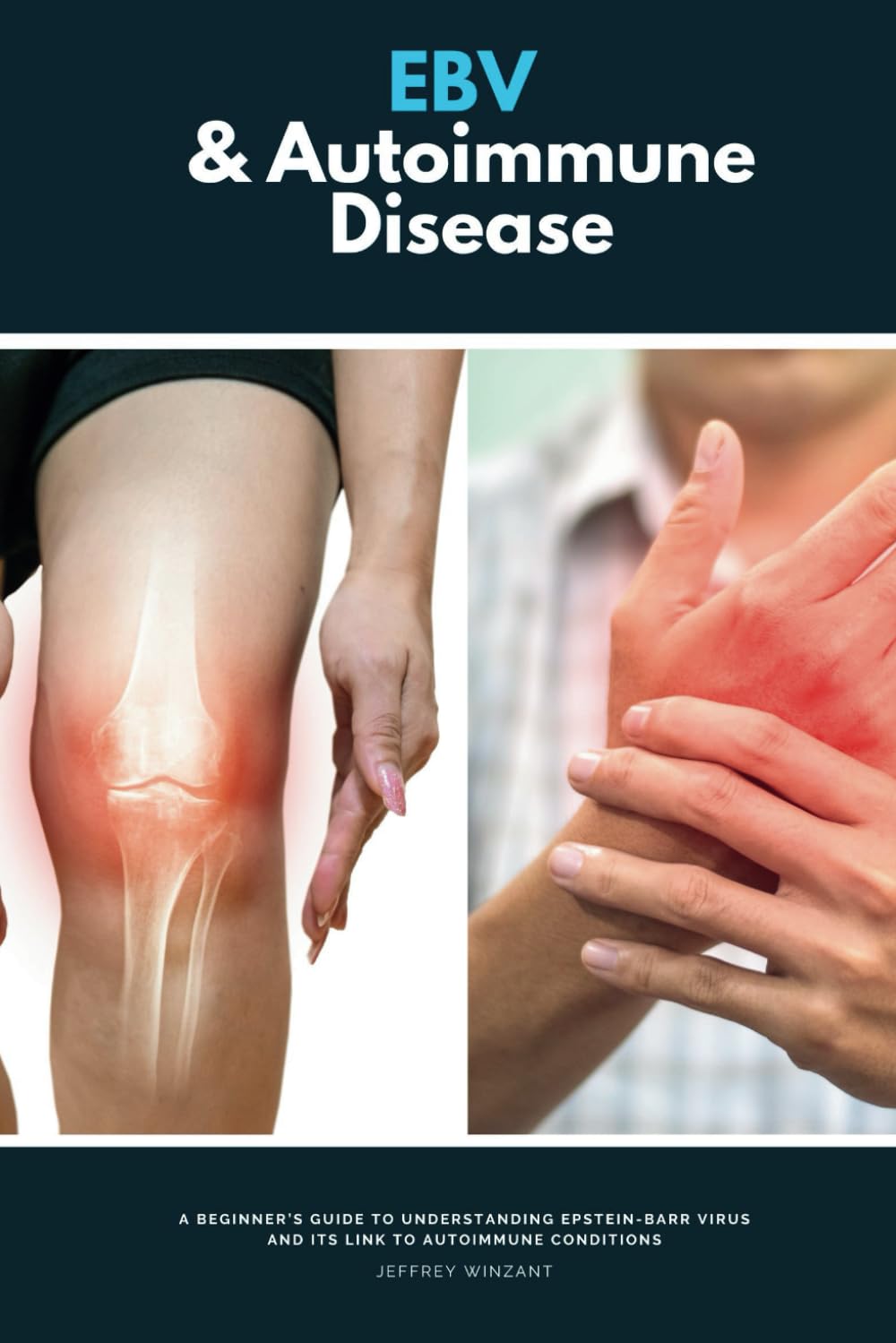 EBV & Autoimmune Disease: A Beginner’s Guide to Understanding Epstein-Barr Virus and Its Link to Autoimmune Conditions