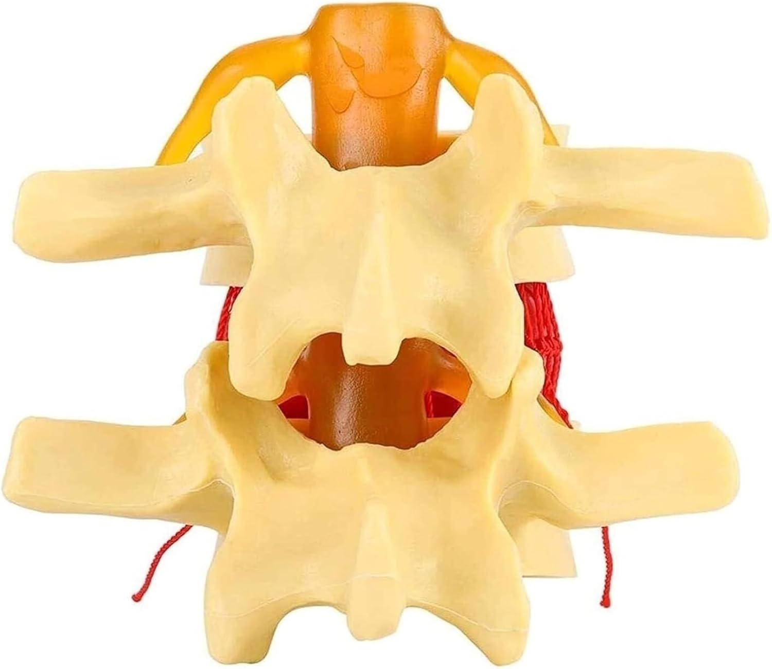Human Lumbar Degenerative Vertebrae Teaching Model, Anatomical