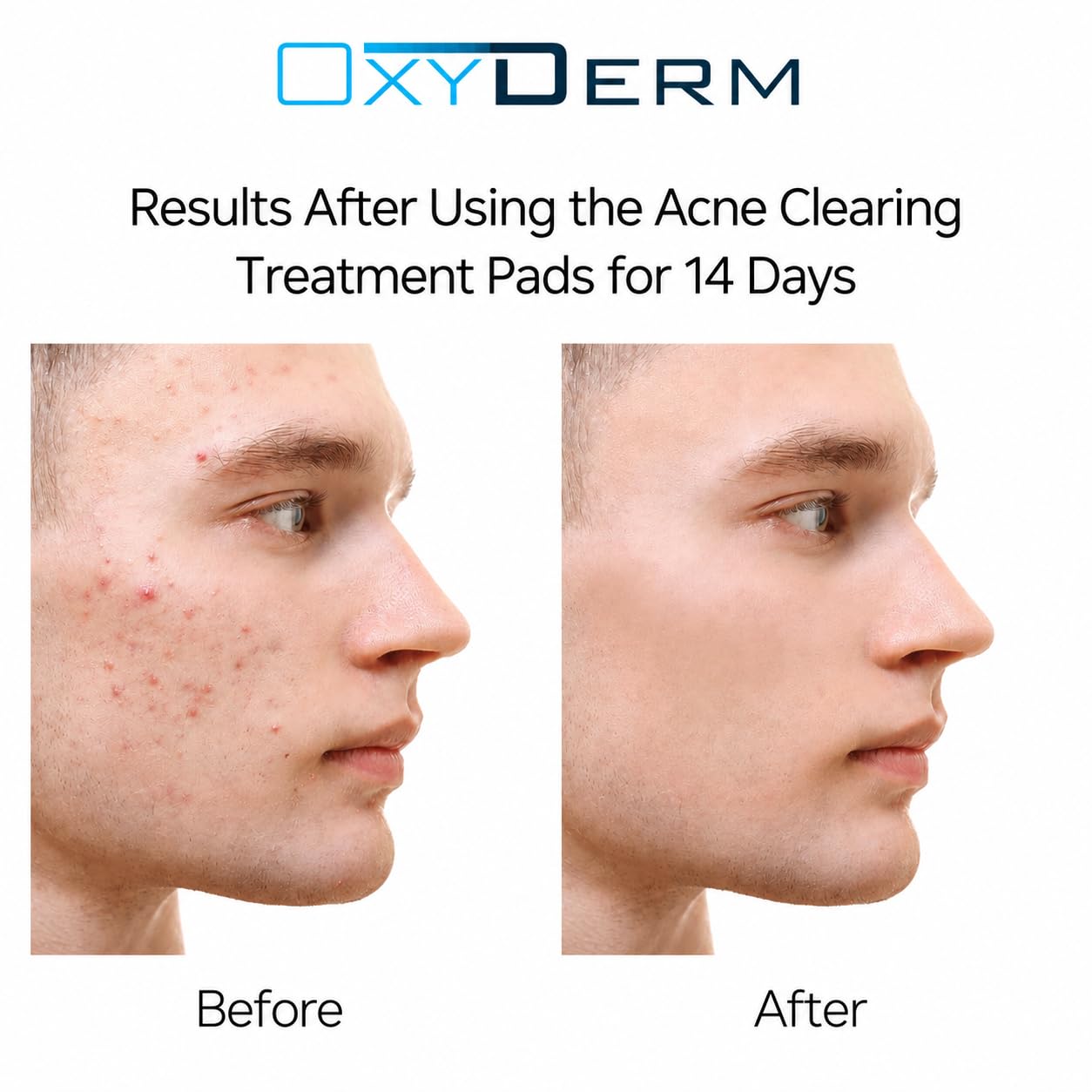 Oxyderm Acne Treatment Pads with Glycolic, Lactic & Salicylic Acids, 60 Count