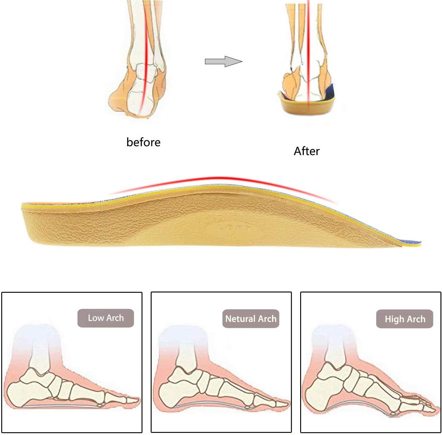 RooRuns Arch Support, 3/4 Orthotic Shoe Inserts for Over-Pronation, Plantar Fasciitis, Heel Pain Relief, High Arch Support Insoles for Men and Women for Running Walking