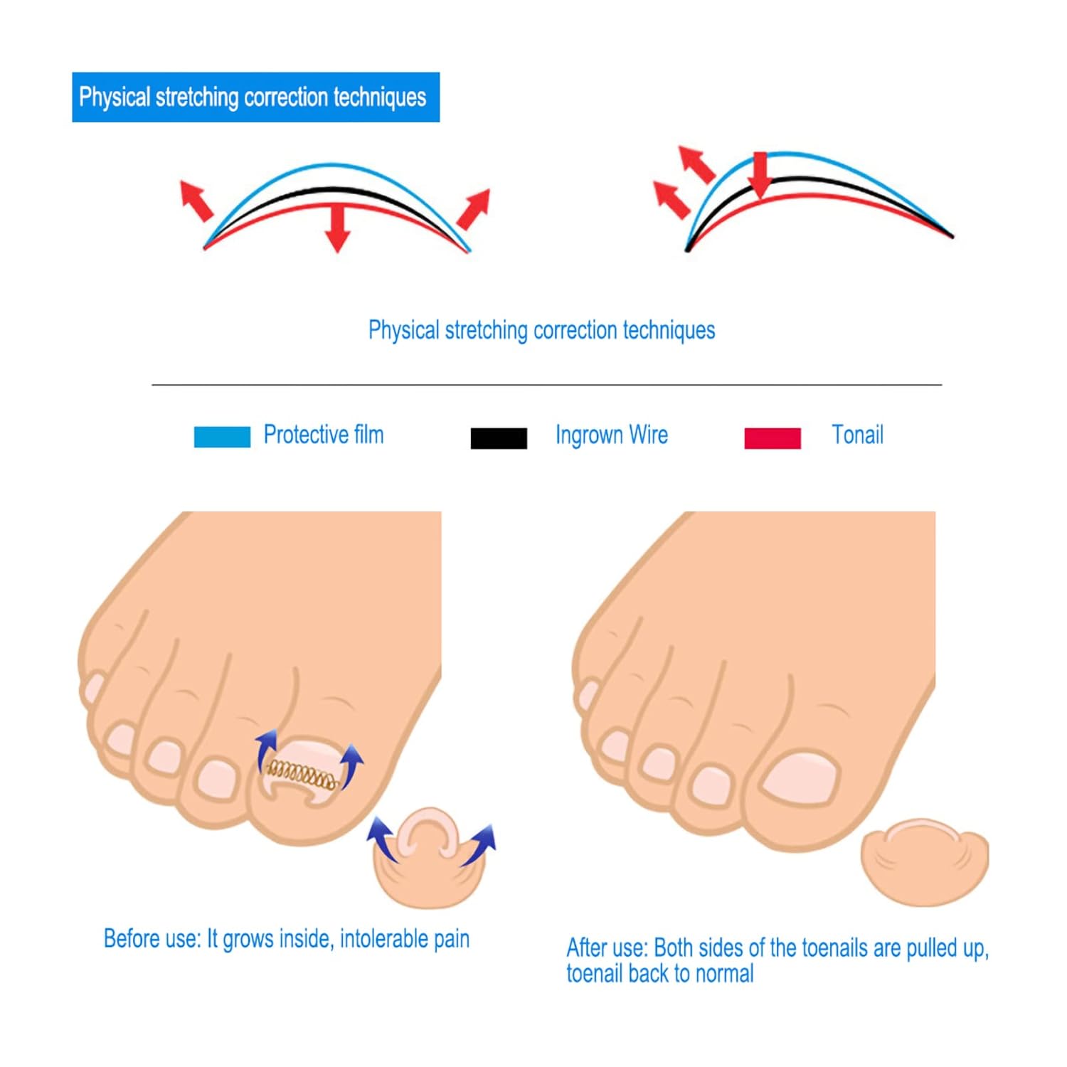 6 Sizes Ingrown Toenail Sticker, Toenail Correction Sticker, Toenail Correction Tool Ingrown Wire Fixer Toe Nail Recover Foot Care(12Pcs/Box) : Beauty & Personal Care