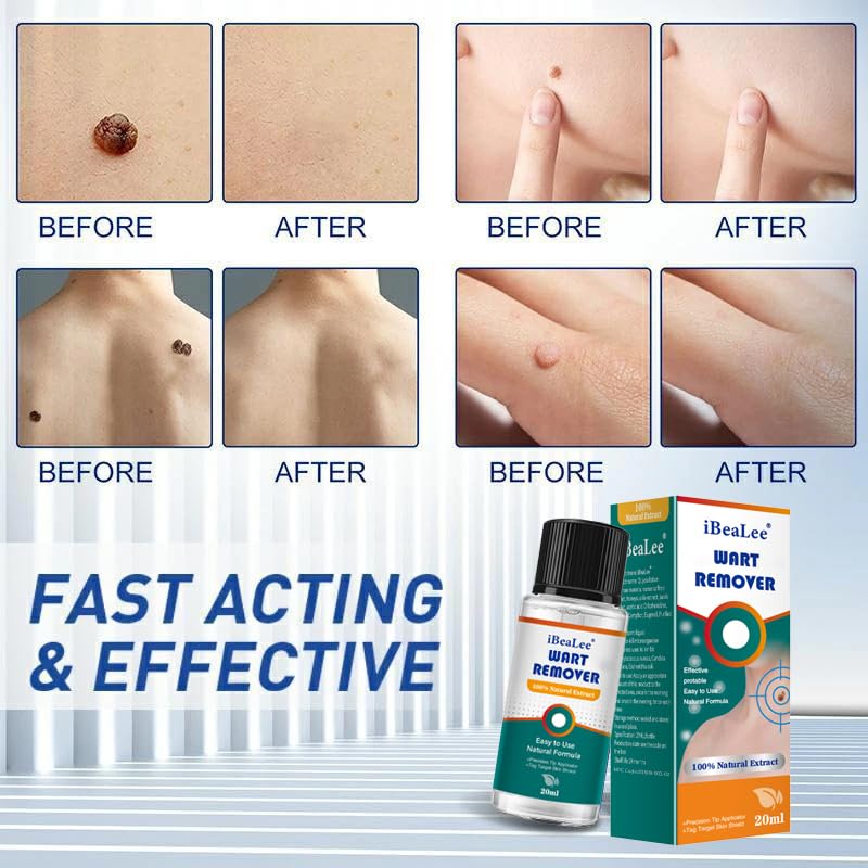 ELEFOCUS Wart Remover Liquid - Botanical-Based Formula for Plantar and Common Warts. Safe and Gentle
