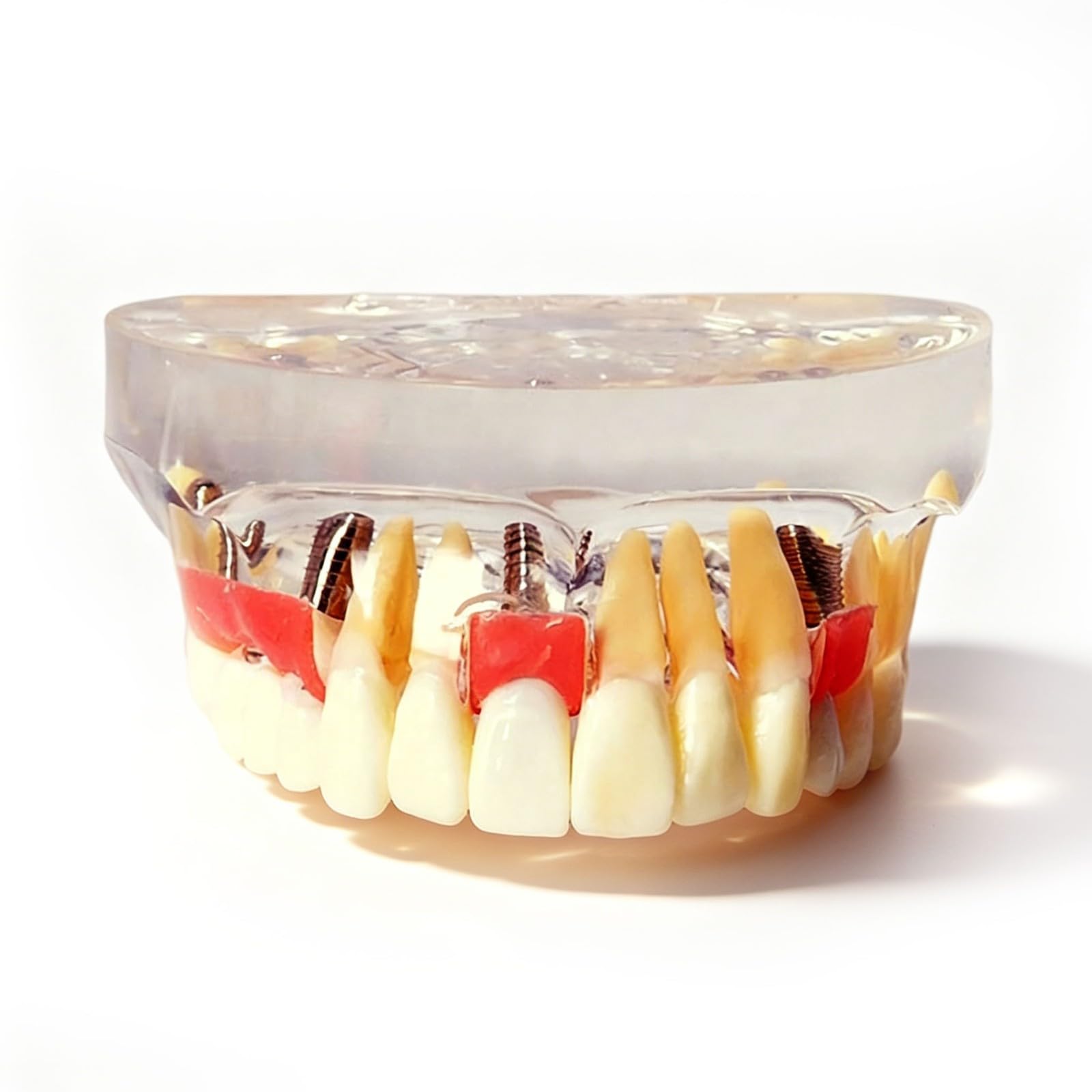 Modello di dente per restauro implantare, Dente Morbido e Bendable Modello dentali superiori con 4 denti superiori, dimostrazione con visione trasparente per studenti di odontoiatria e formazion