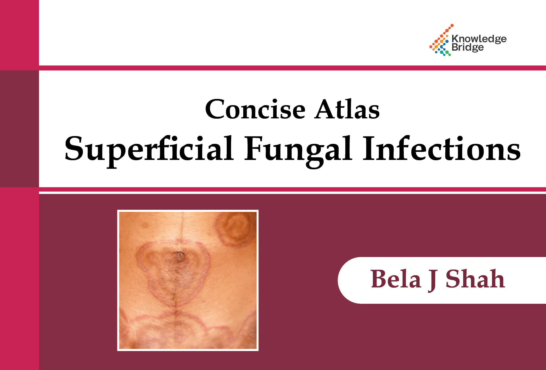Buy Concise Atlas - Superficial Fungal Infection Book Online at Low ...
