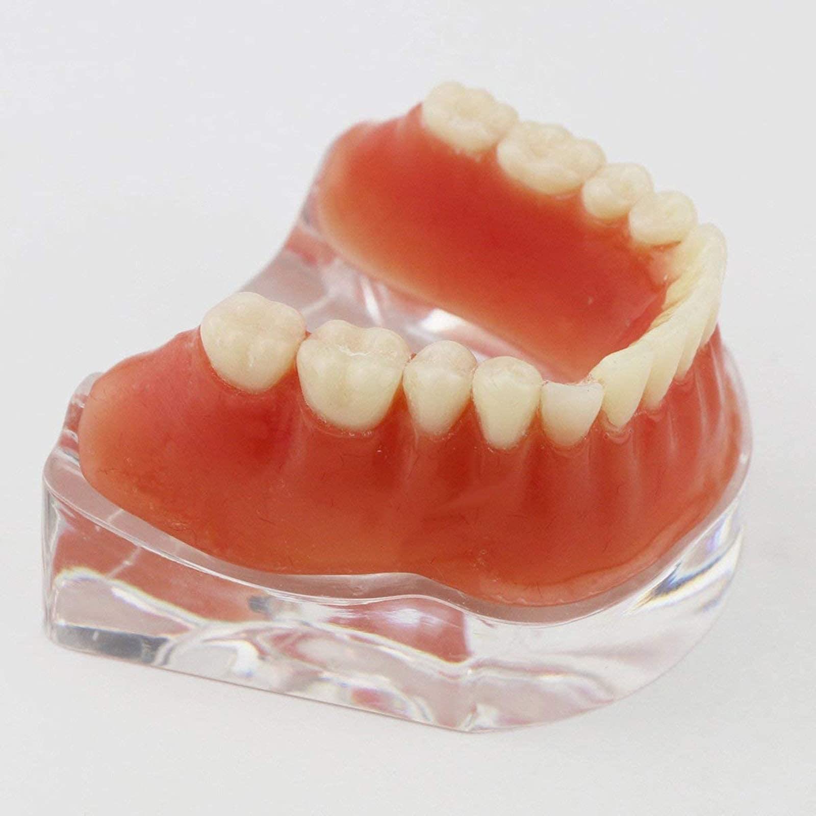 Modelo de dientes de sobredentadura dentales Modelo de restauración dental con 4 implantes Demostración de implantes de precisión inferior de sobredentadura, modelo de dientes de estudio de enseñanza