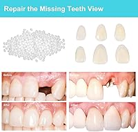Vista 3 de Kit de reparación de dientes para llenar los dientes rotos y huecos que faltan - Kit de repuesto moldeables de dientes falsos y cuentas térmicas