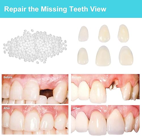Miniatura 3 de Kit de reparación de dientes para llenar los dientes rotos y huecos que faltan - Kit de repuesto moldeables de dientes falsos y cuentas térmicas