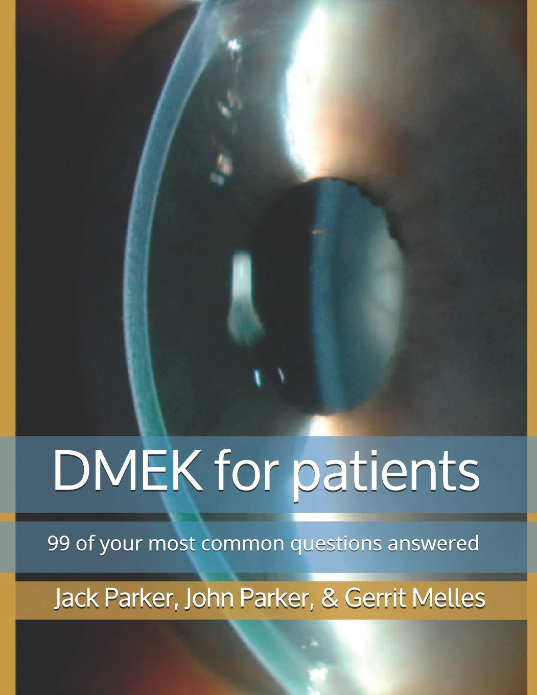 DMEK for patients: 99 of your most common questions answered