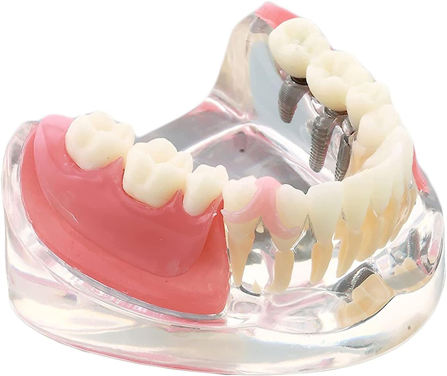 Model anatomiczny ludzkiego tułowia, Model odbudowy implantu dentystycznego do nauczania w szkołach dentystycznych z wyjmowanymi zębami