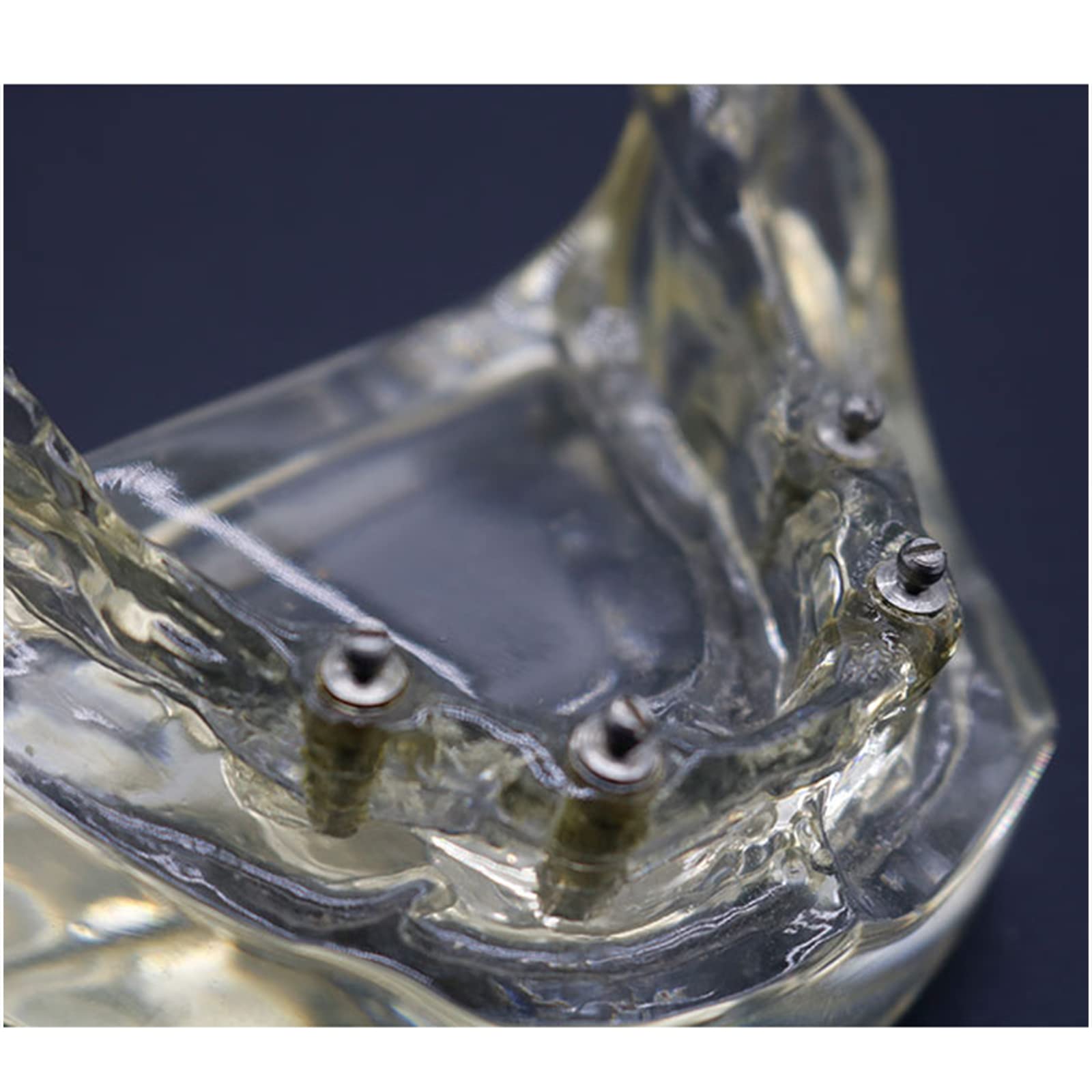 Implant Typodont model zębów - model szkoleniowy implantu dentystycznego - z miękkimi dziąsłami, do nauczania przedmiotów ścisłych, narzędzie komunikacji lekarz-pacjent (B)