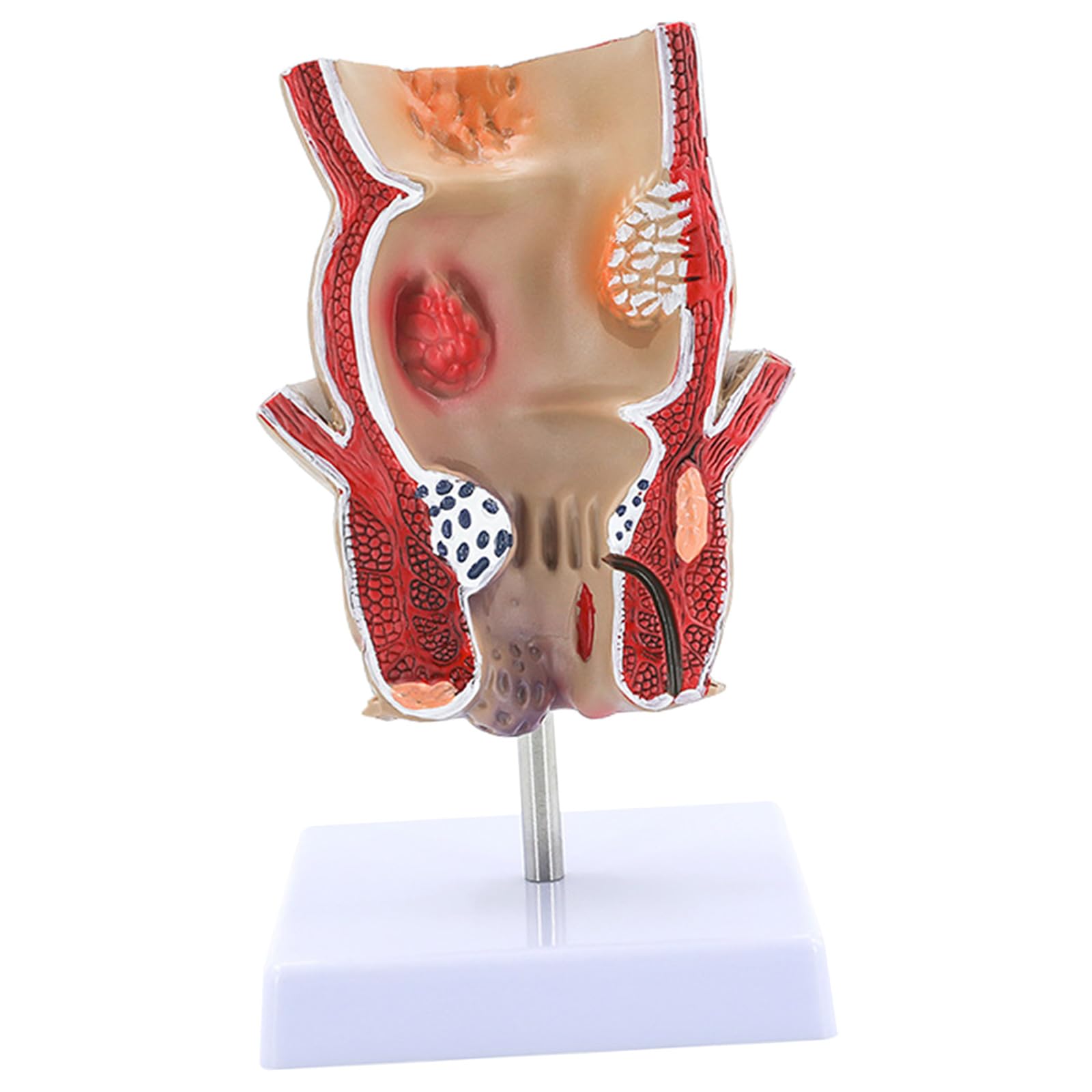 Xiaoxu Modèle de Rectum pour travaux Pratiques en Anatomie Humaine : Pathologies du Rectum, Outil pédagogique en Anatomie.
