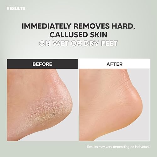 Miniatura 5 de S-Line Lima de Pies de Esmeril, Herramienta de Pedicura Colosal de Doble Cara, Eficaz para Talón Agrietado, Diseño Ergonómico para Agarre Fácil