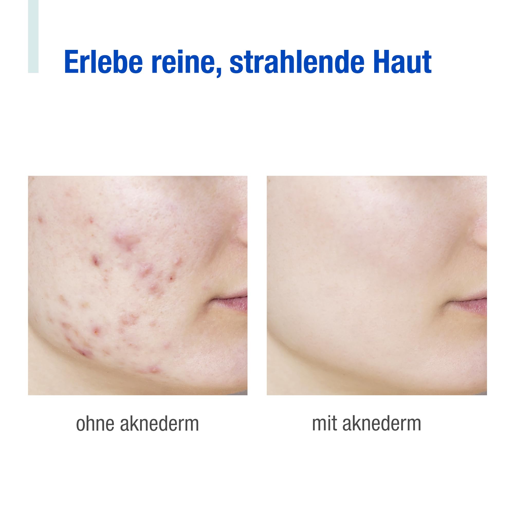 aknederm pure Reinigungsmaske 12 x 6ml I klärende Gesichtsmaske mit Lotus-Extrakt I mattierende Porzellanerde-Maske entfernt Hautfett I Anti-Glanz Maske Gesicht für gründliche Reinigung