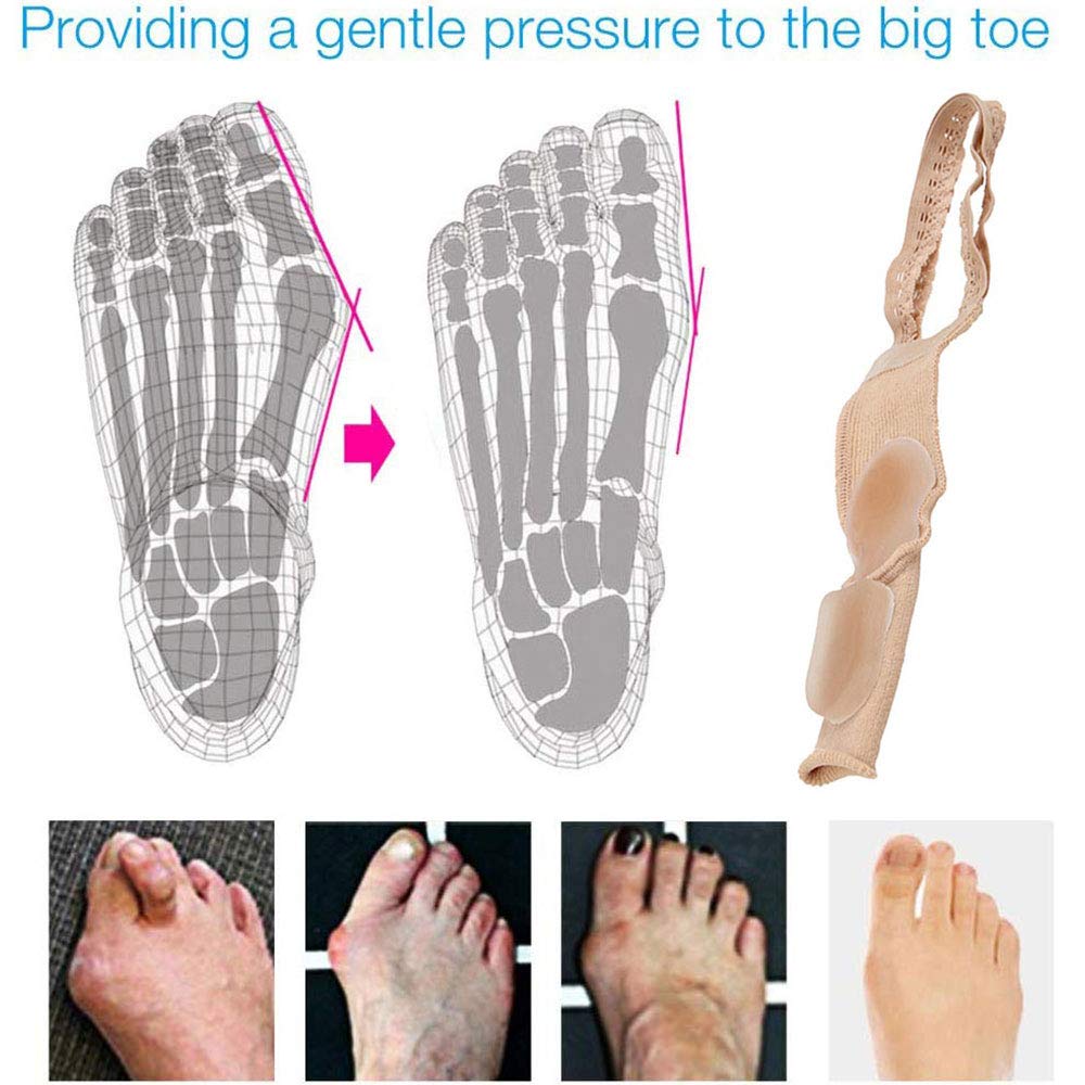 4 Pieces Hallux Valgus Correction by Pedimend - Orthotics Big Toe Straightener Belt - Silicone Gel Bunion Splint - Smoothing Bent Toes - Big Foot Alignment - UNISEX - Foot Care