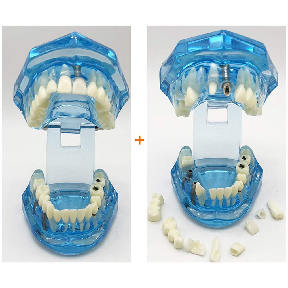 Modello di Denti da 2 Pezzi, Modello di Analisi di Studio di Impianti Dentali per Riparazione di Carie Dentale, Modello Dimostrativo per L'Insegnamento Medico, Forniture di Laboratorio