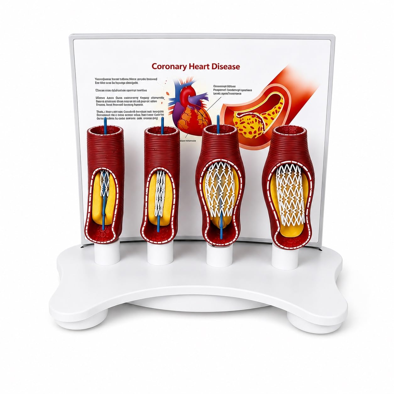 TQPGJJL Professional Human Vascular Stent Model – Enlarged PVC Anatomical Coronary Artery with Blockage Demonstration, Precision Teaching Aid for Medical Training and Cardiology Education