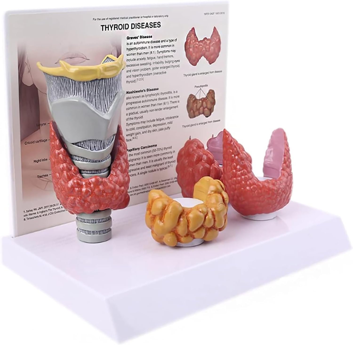 Modèle de glande thyroïde humaine, modèle d'anatomie normale et pathologique de la thyroïde humaine, échelle 3:1, illustrant le système digestif pathologique de la thyroïde. Modèle d'étude anatomique