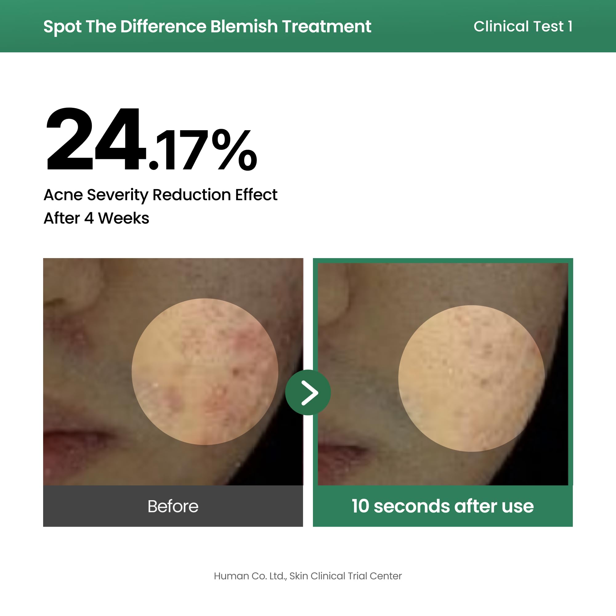 AXIS-Y Spot The Difference Blemish Treatment serum do skóry trądzikowej i skłonnej do niedoskonałości 15ml