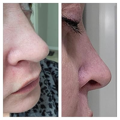 Buy Microderm Glo Diamond Microdermabrasion Machine And Suction Tool Clinical Micro Dermabrasion Kit For Tone Firm Skin Advanced Home Facial Treatment System Exfoliator For Bright Clear Skin Online In Turkey