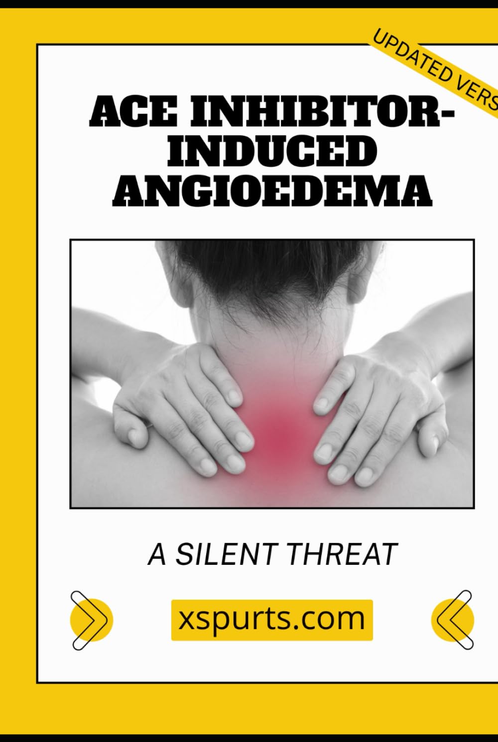ACE Inhibitor-Induced Angioedema: A Silent Threat