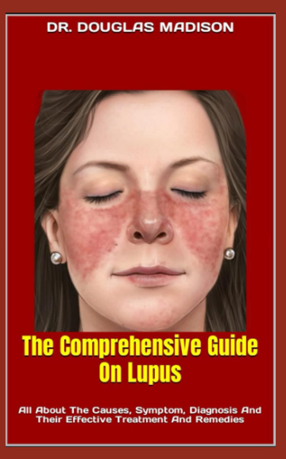 Buy The Comprehensive Guide On Lupus All About The Causes, Symptom Buy The Comprehensive Guide On Lupus All About The Causes, Symptom