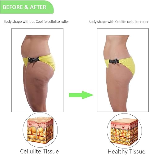 Miniatura 8 de Coolife Fascia Blasting Muscle Roller - Rodillo para masaje muscular, masajeador de celulitis, rodillo para fascia para celulitis y músculos