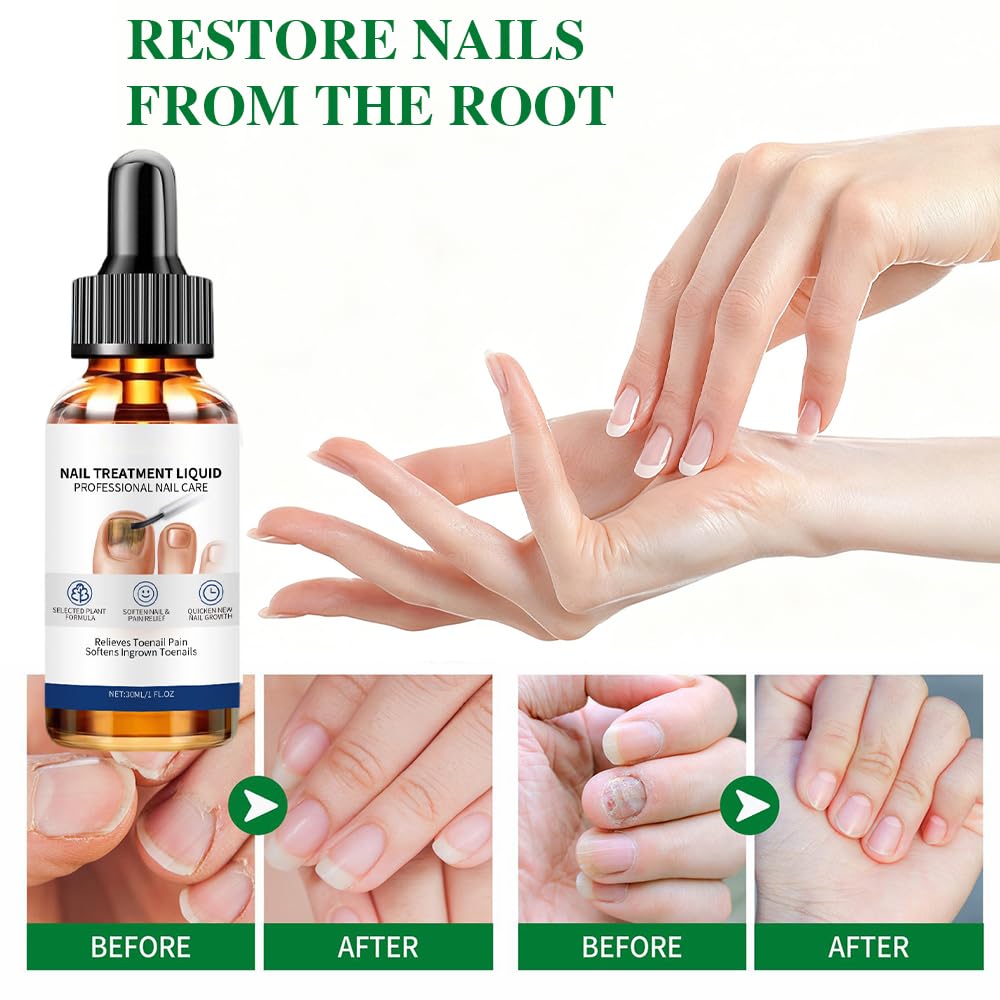 Płyn do pielęgnacji paznokci, serum do regeneracji paznokci, naprawia suche, łamliwe i przebarwione paznokcie (10 ml)