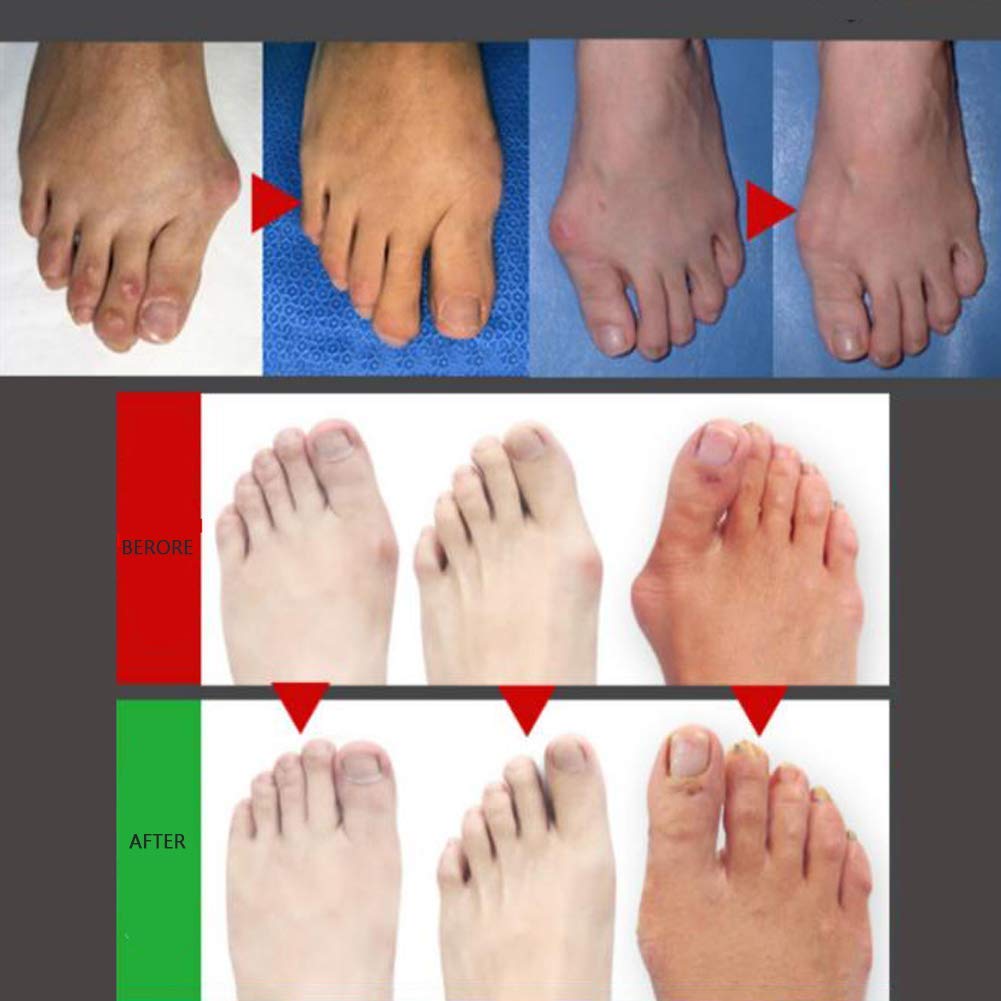 Daumen Valgus Corrector Einstellbarer Druck, Bunion Correctors Rutschfester Verschleiß Atmungsaktive Komfortkorrektur Schmerzlinderung Unisex Beige-Right-S