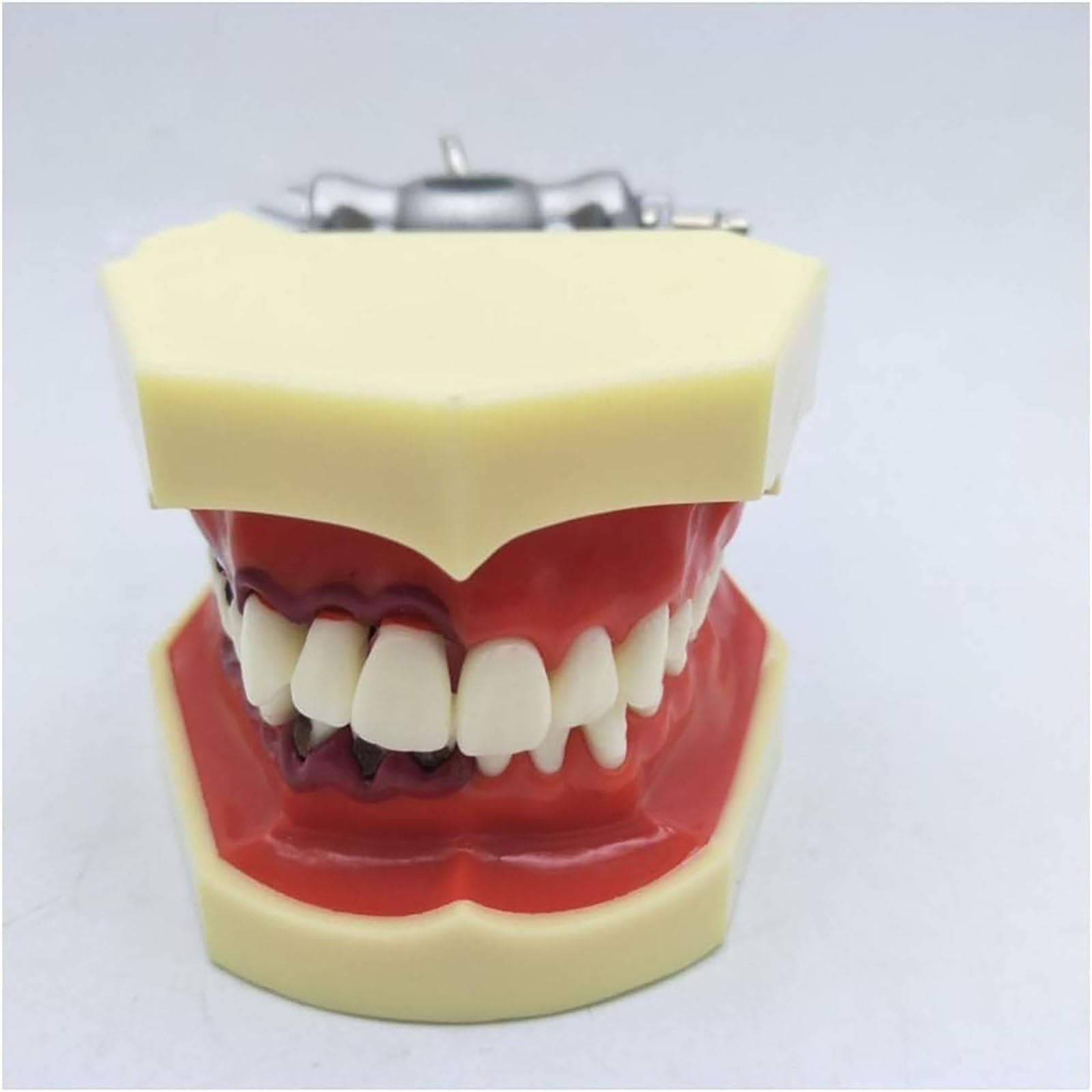 Parodontalpathologisches Zahnmodell mit abnehmbarer Gingiva, Demonstrationsmodell for die zahnmedizinische Patientenaufklärung for Zahnärzte und mündliche Unterrichtskommunikation