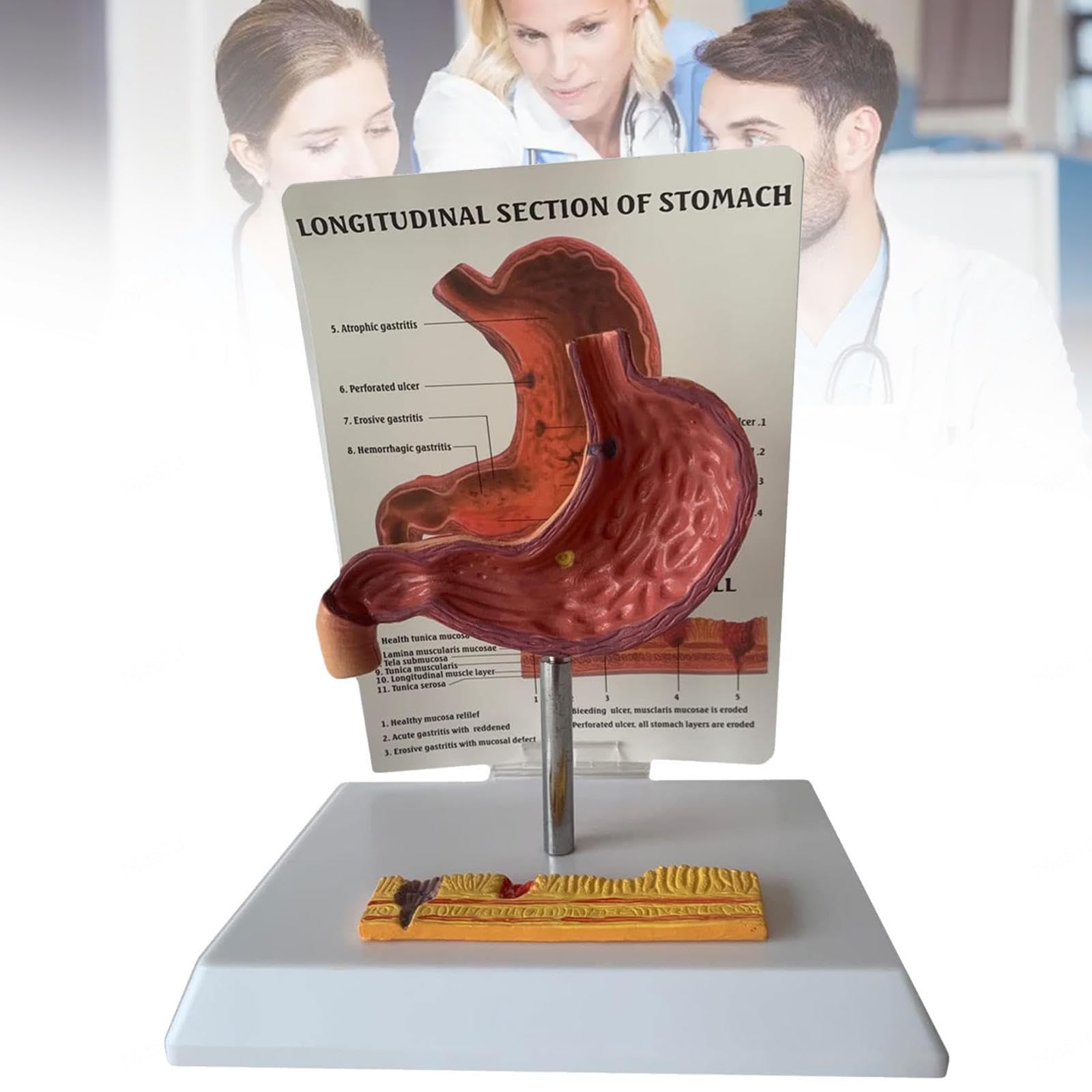 Anatomical model of the stomach, pathological Human gastric ulcer, medical for learning, exposure and teaching Medicine
