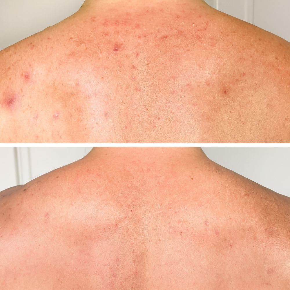 Lozione corpo con acido salicilico (200 ml) – per imperfezioni, pelle secca e grassa. Con BHA, niacinamide e acido ialuronico per esfoliare e idratare