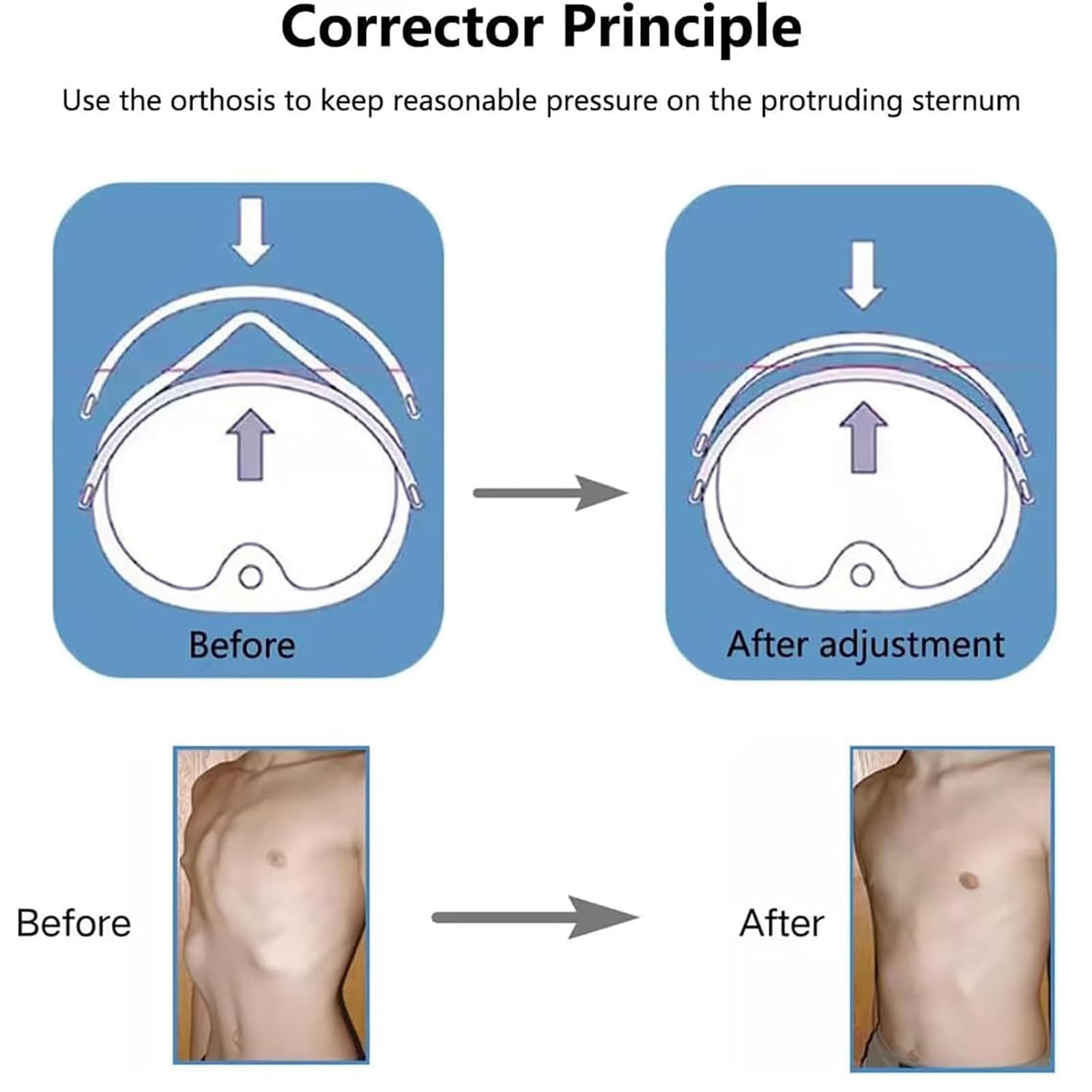 Générique Orthèse pour Pectus carinatum, attelle pour Sternum déformé