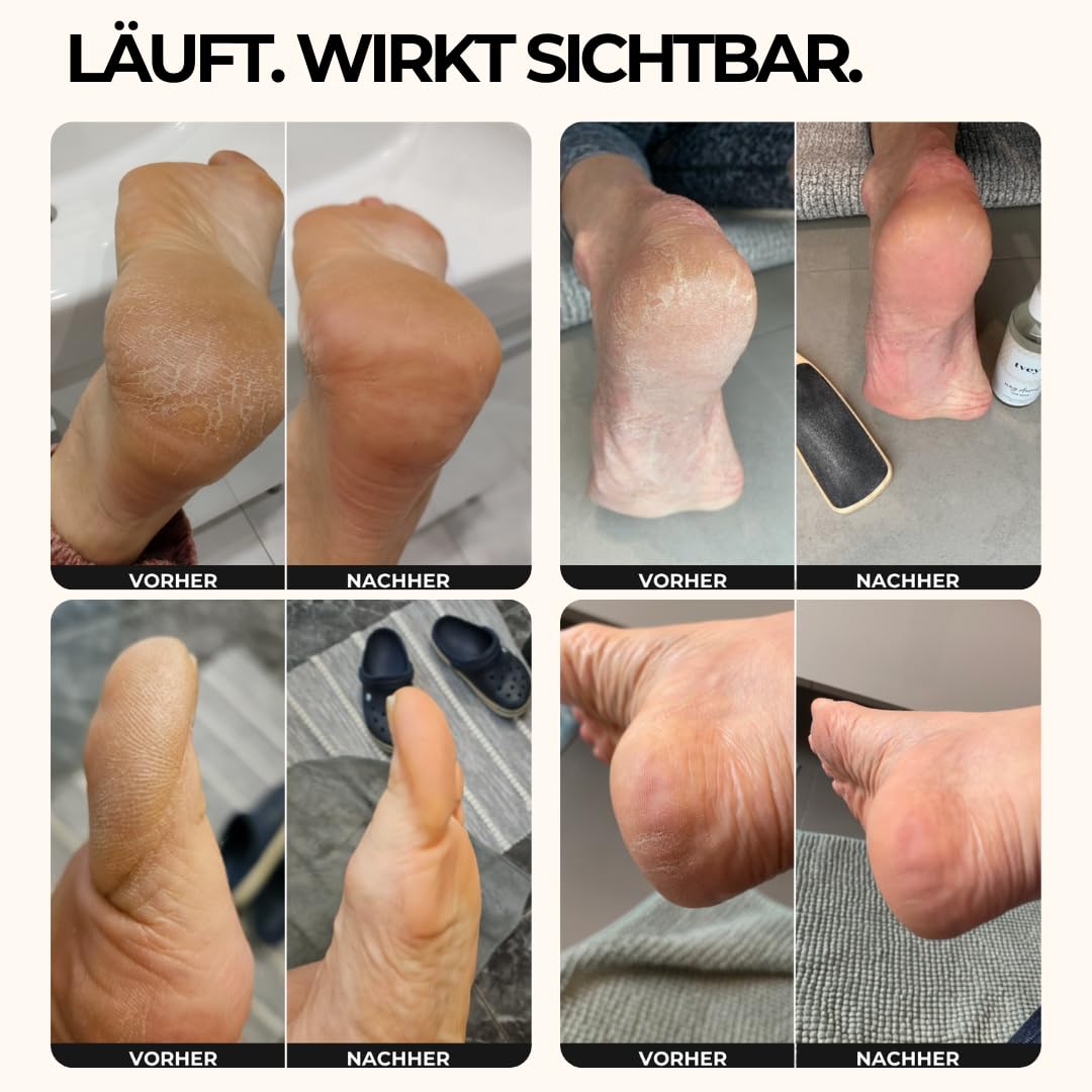 tvey" Fußcreme für sehr trockene Füße mit 10% Urea, Sheabutter & Avocadoöl - Effektive Fusscreme gegen starke Hornhaut - Fusspflege Anti Hornhaut ohne klebrige Hände - Made in Germany 75ml Vegan