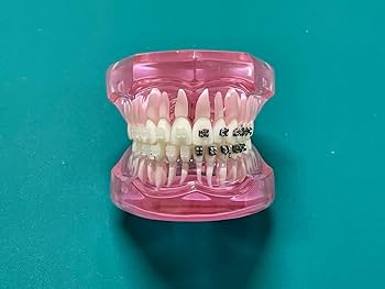 歯科　上顎全部金属床、メタルフレーム、上顎無歯顎模型　説明用 Amazon.co.jp: 歯科模型 歯列模型 顎模型 歯列矯正 ブラケット