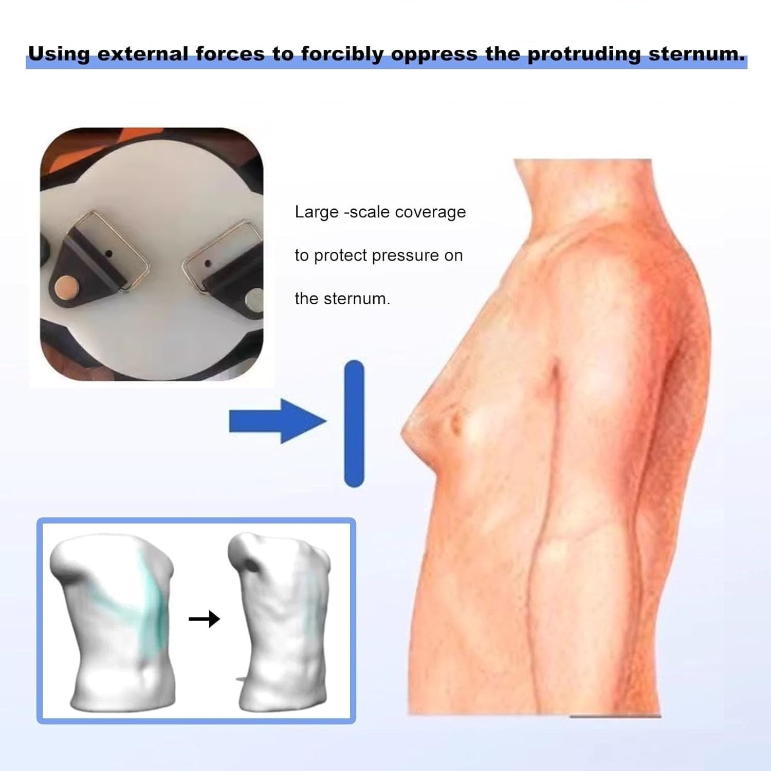 Pectus Carinatum Brace - Ortesis de fijación torácica ajustable para todas las edades - Soporte corrector de costillas valgus