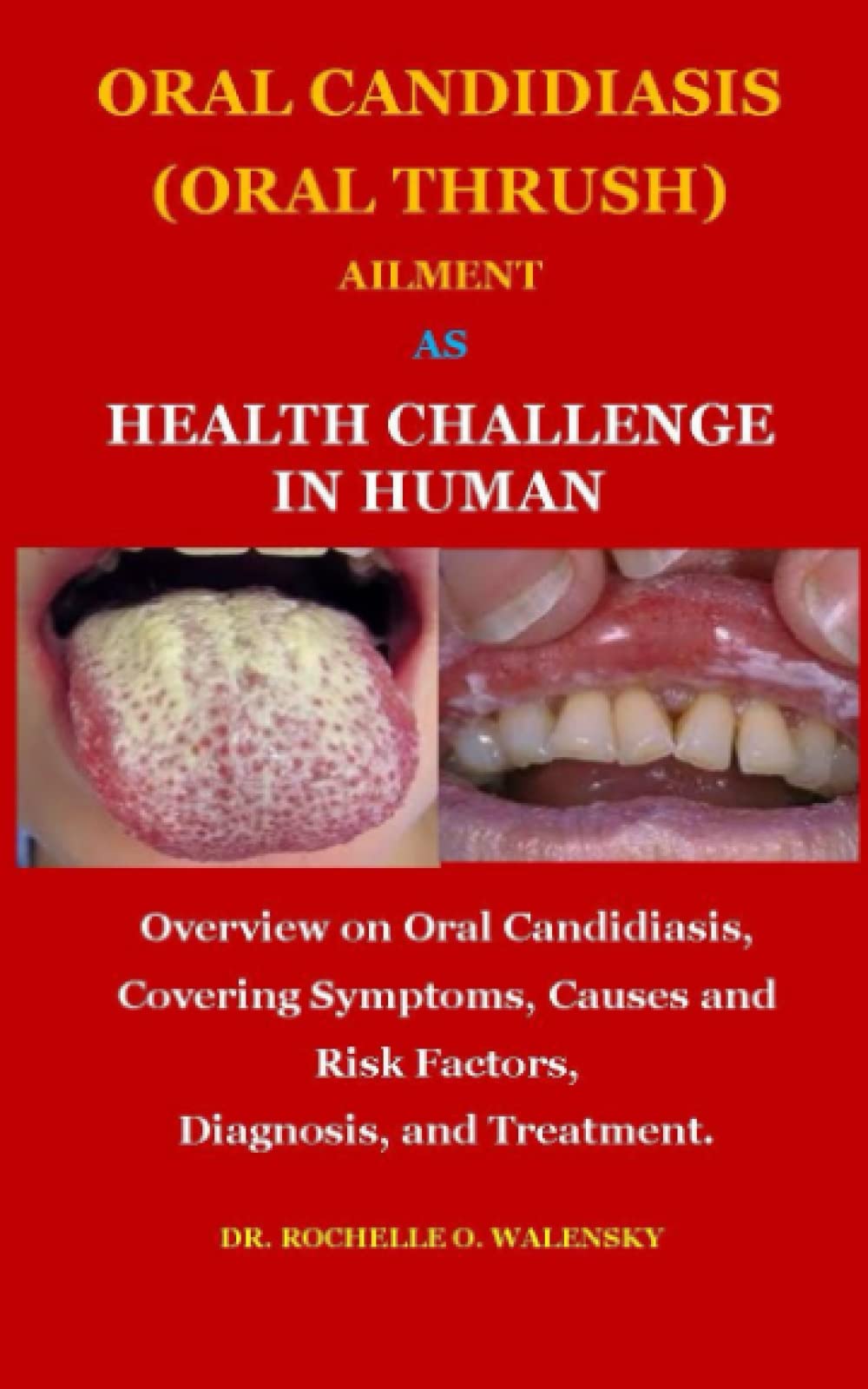 Buy ORAL CANDIDIASIS (ORAL THRUSH) AILMENT AS CHALLENGE IN HUMAN