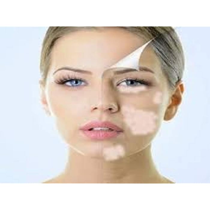 Buy Zyrex Vitiligo Nill Malham (Ointment)100 Gram An Ayurvedic Remedy