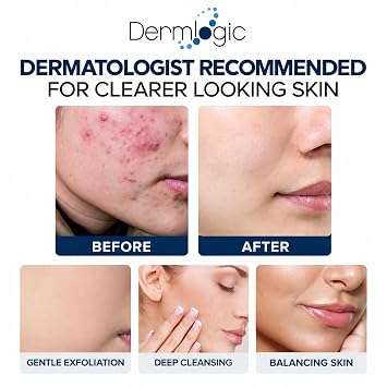Dermlogic Acne Treatment Pads-Contains Glycolic, Lactic, Salicylic Acid. Eliminates Oily Skin, Clogged Pores & Cystic Breakouts. Removes Dark Spots, Whitehead & Blackhead Pimples for Face & Body.