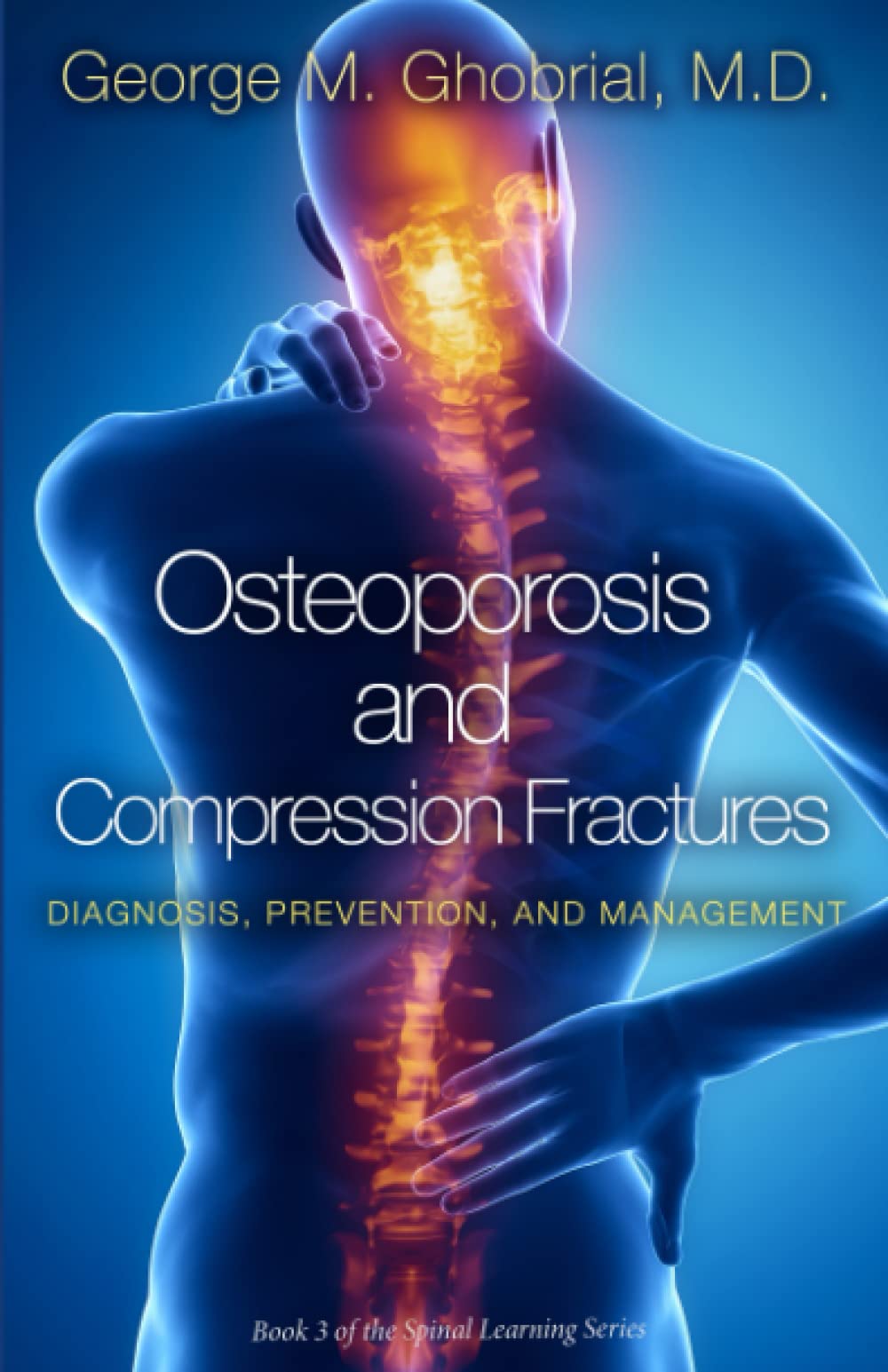 Osteoporosis and Compression Fractures: Diagnosis, Prevention, and Management
