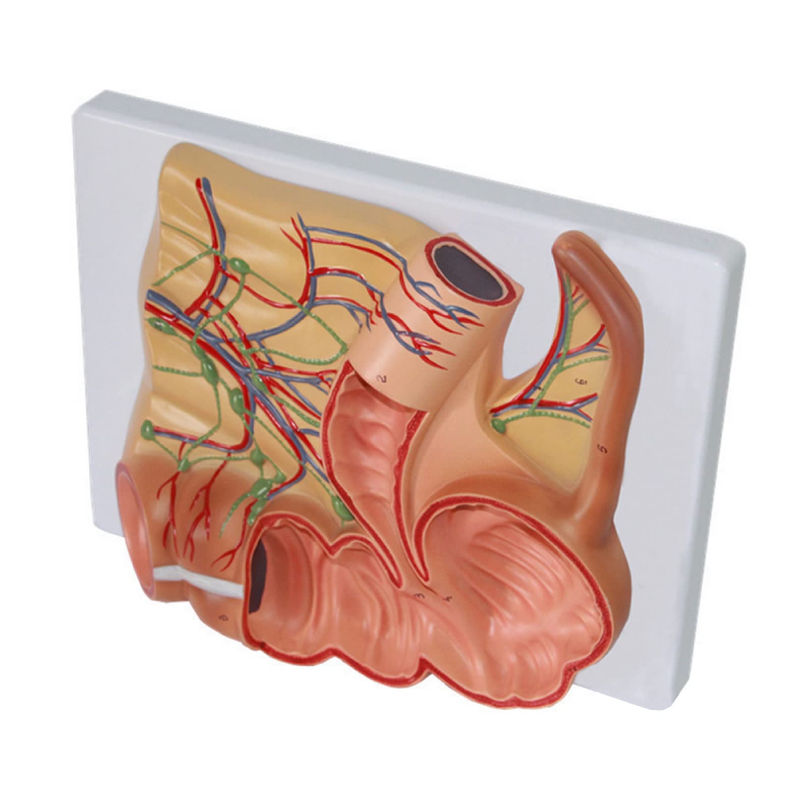 Apéndice Humano Real Appendicitis Wikipedia