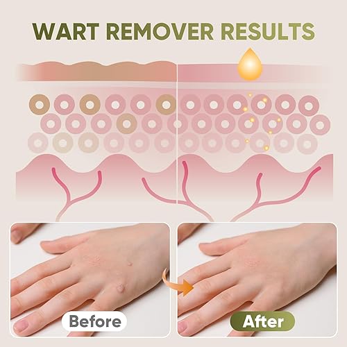 Miniatura 5 de "STAY STOKED" Kit de eliminación de marcas cutáneas de 0.5 fl oz, removedor de marcas cutáneas en el hogar, congelación de verrugas de acción rápida