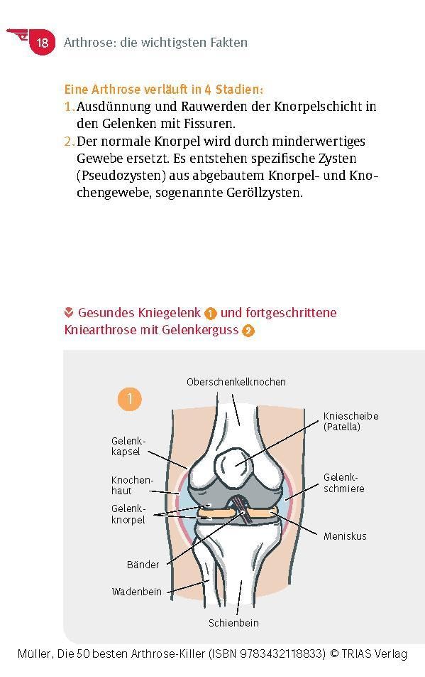 Die 50 besten Arthrose-Killer